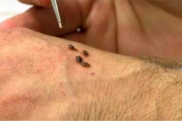 bed bugs on skin